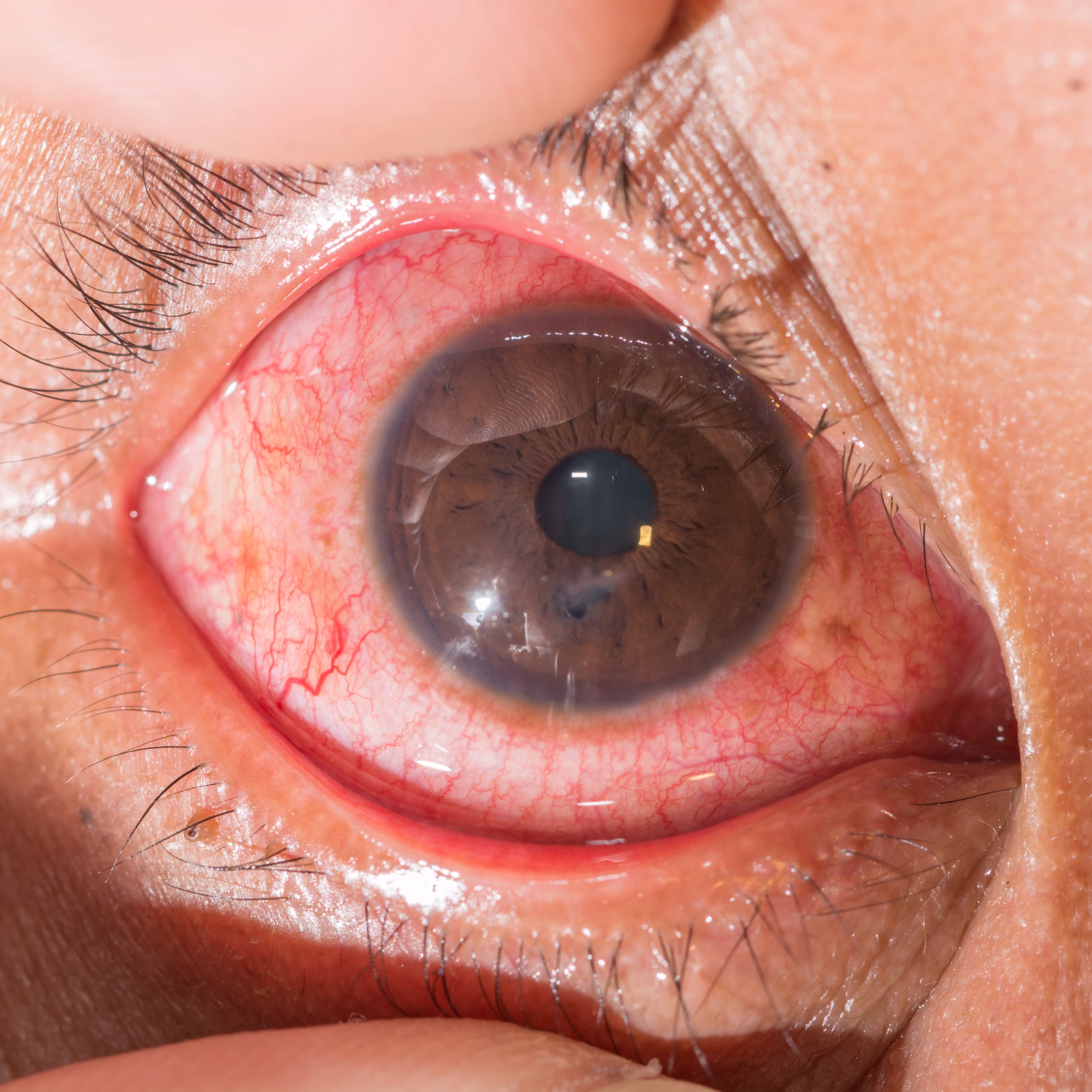 Close,Up,Of,The,Penetrating,Eye,Ball,Injury,During,Eye blessures à lœil, FIMUQ