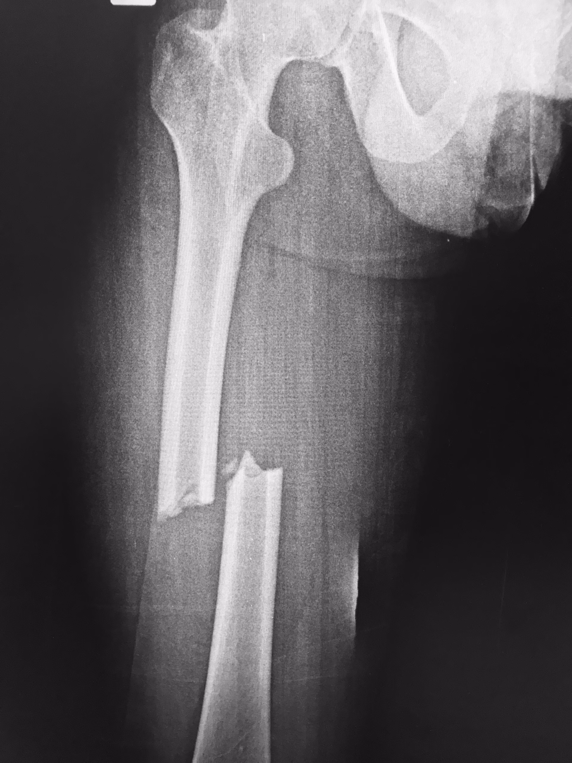 blessures à la tête colonne vertébrale et bassin, FIMUQ